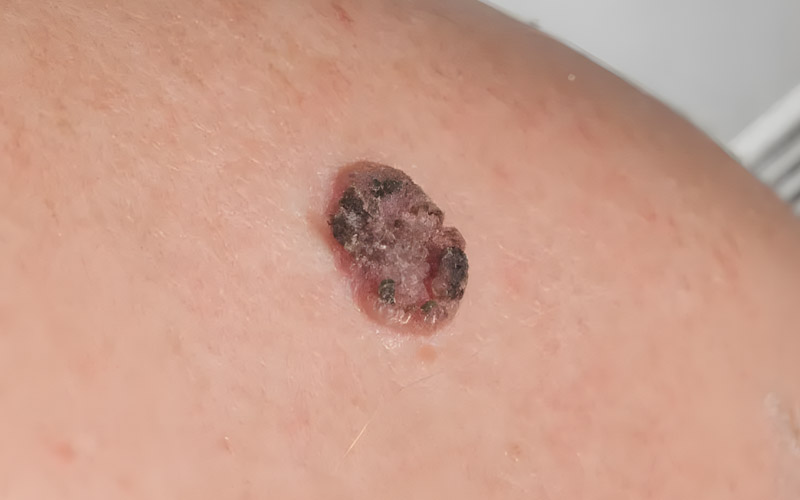 Cáncer de piel