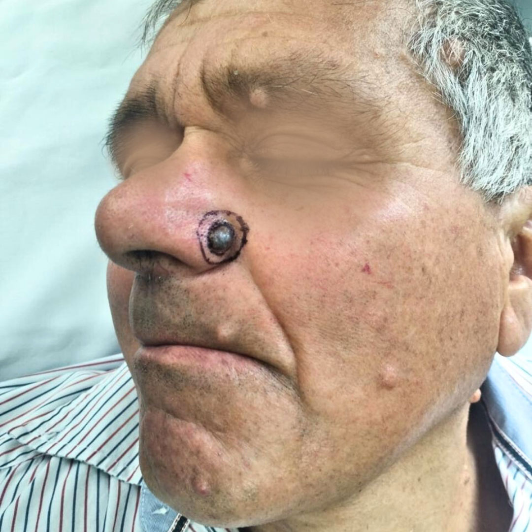 Carcinoma basocelular