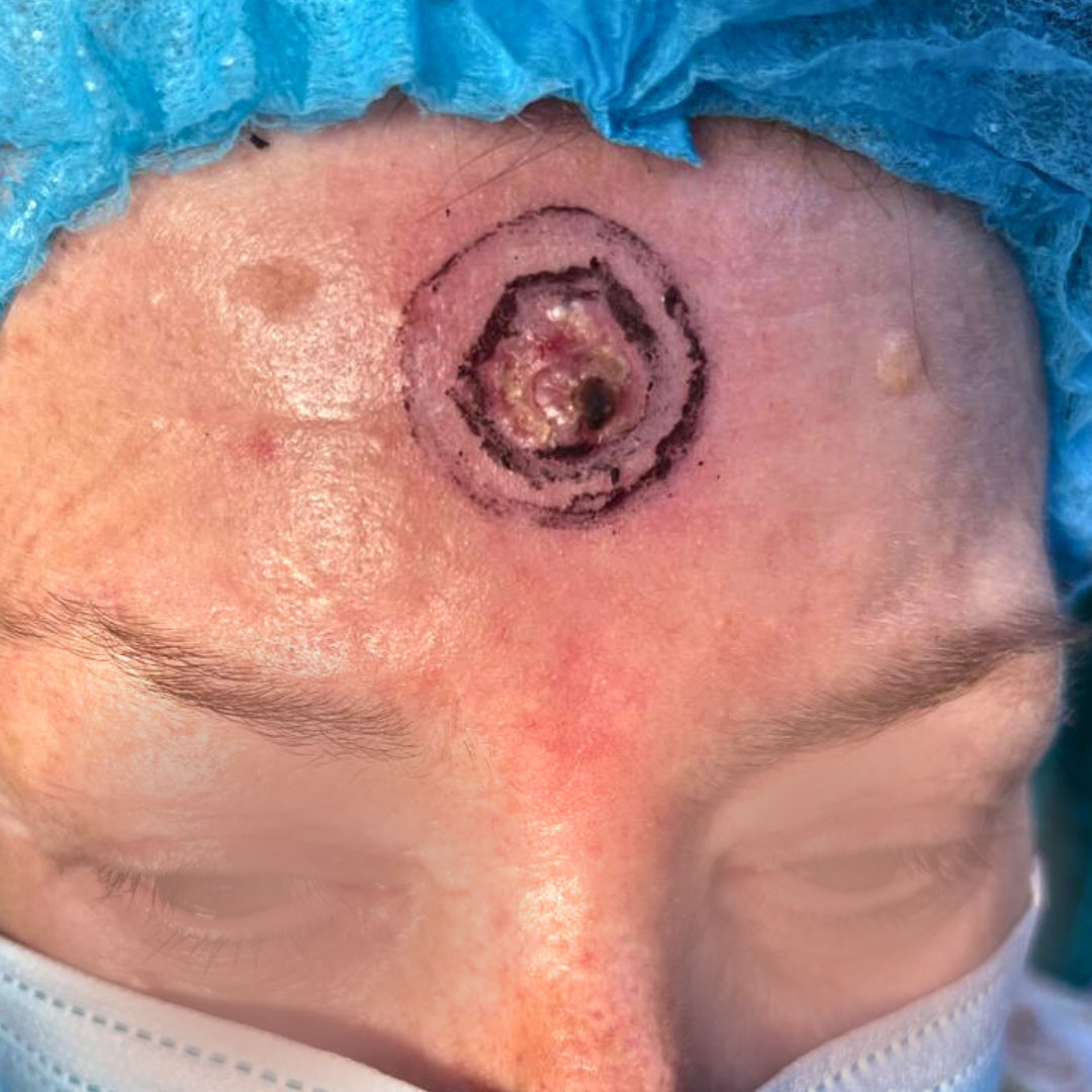 Carcinoma basocelular