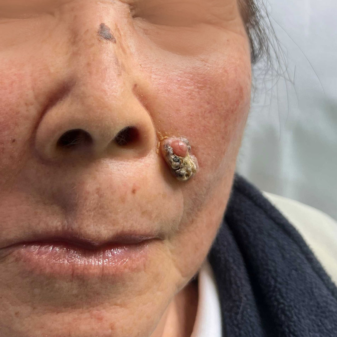 Carcinoma basocelular