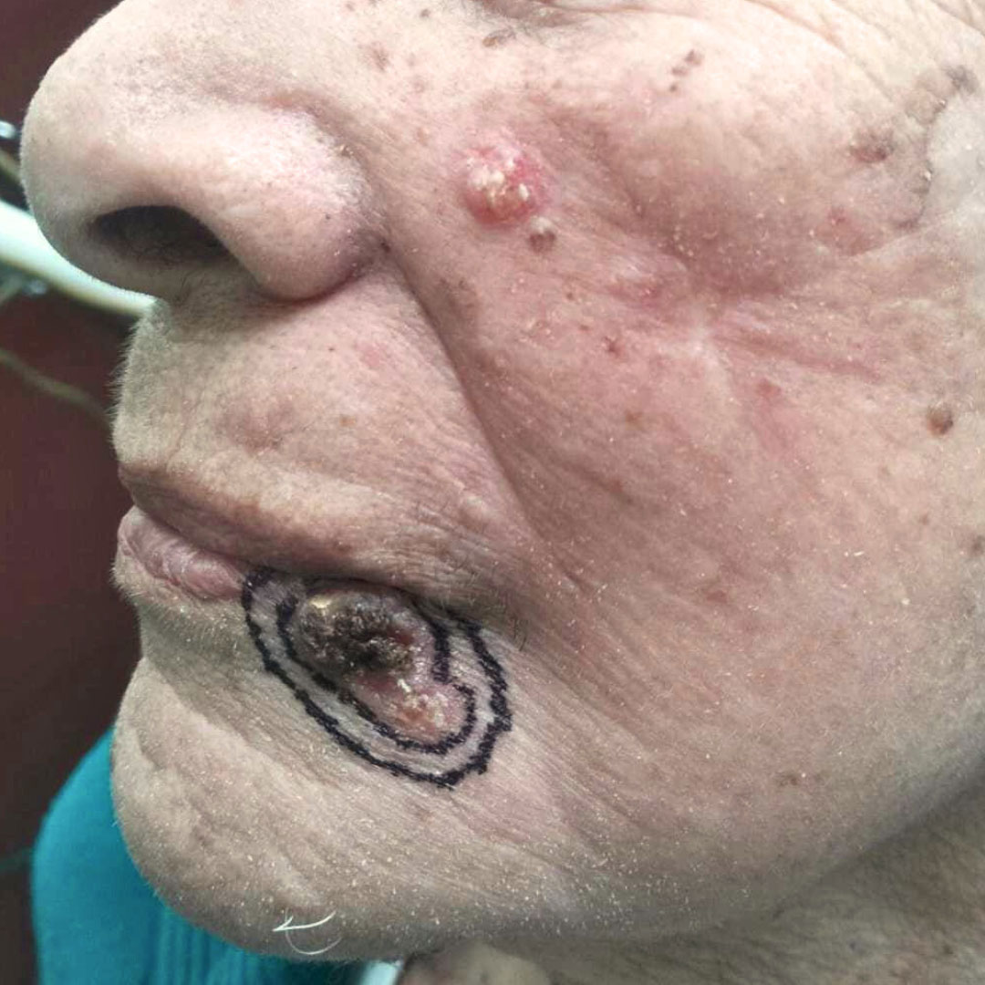 Carcinoma basocelular