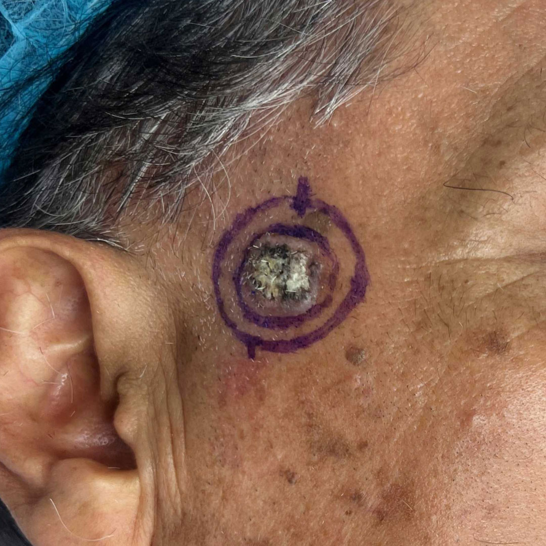 Carcinoma basocelular