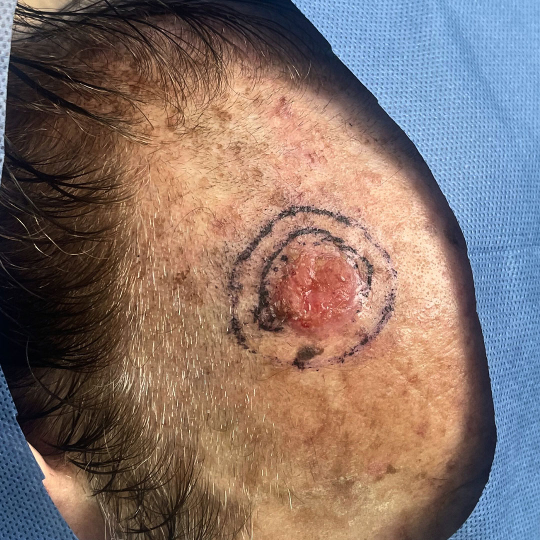 Carcinoma basocelular