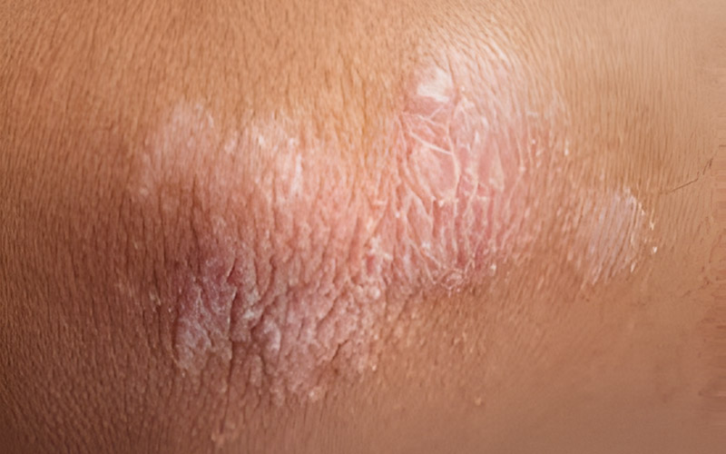 Psoriasis